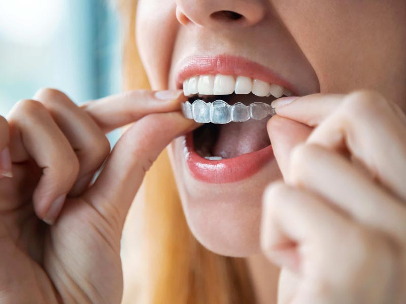 Clear dental aligners displayed for orthodontic treatment in Mesa, AZ