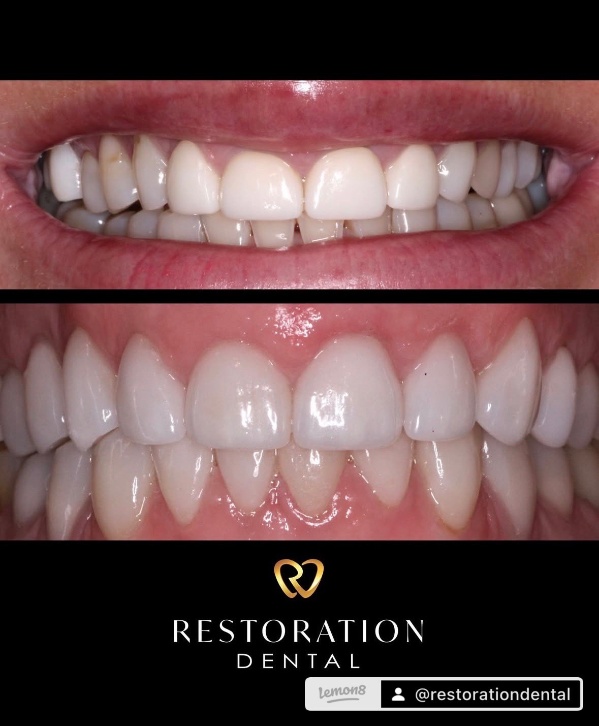 Set of dental veneers for cosmetic smile enhancement in Mesa, AZ