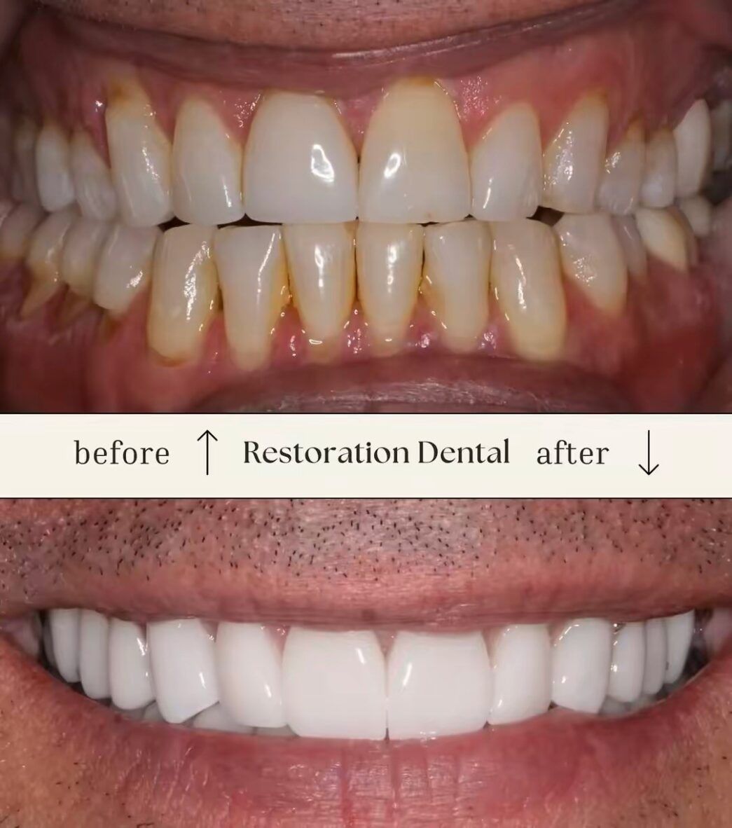 Before and after teeth whitening photos showcasing results from One Day Crowns in Mesa, AZ