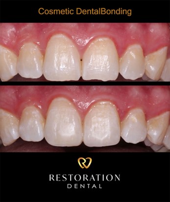 How Long Does Dental Bonding Take? featured image