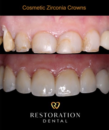 How Long Can a Temporary Crown Last and Reasons to Get a Same-Day Crown Instead featured image