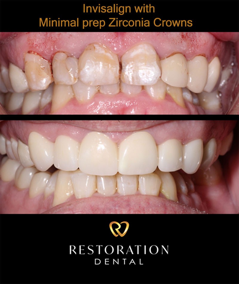 Invisalign treatment with minimal prep zirconia crowns in Mesa, AZ, by a cosmetic dentist
