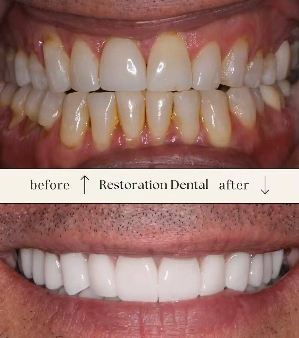 Professional teeth whitening treatment delivering brighter smiles in Mesa, AZ